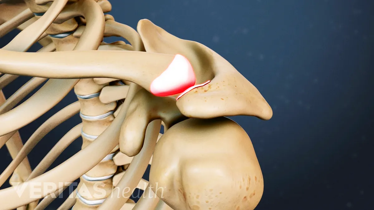 khớp vai, phức hợp vai, bài tập vai, cơ vai, khớp cùng đòn, Acromioclavicular joint, AC join, HFI, HT Fitness, Học viện HFI