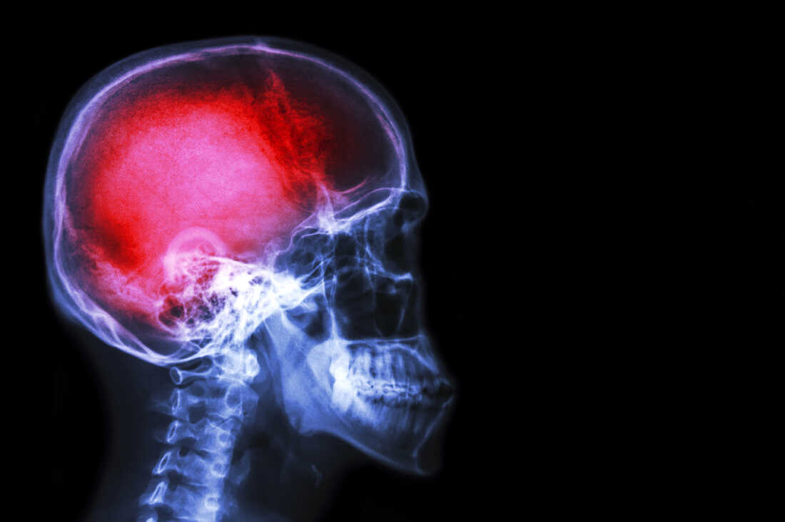 đau cơ, cơn đau, HFI, HT Fitness, Học viện HFI