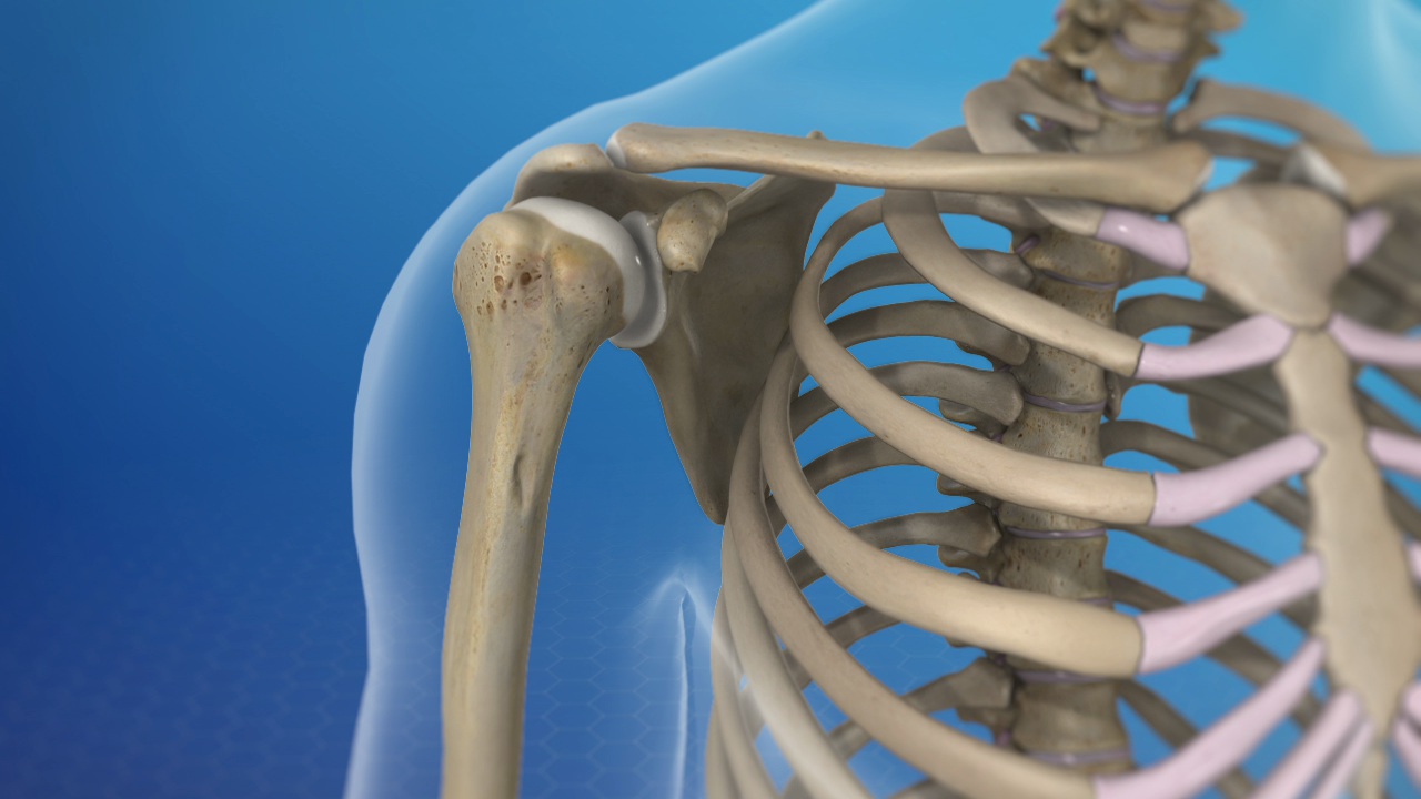 Một trong những yếu tố khiến tỷ lệ trật khớp vai cao là khớp vai là khớp linh hoạt nhất cơ thể, nhưng đồng thời cũng là khớp kém ổn định nhất