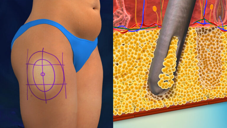 Hút mỡ là một thủ thuật thẩm mỹ xâm lấn được thực hiện bởi chuyên gia y tế