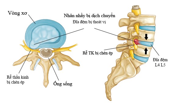 Hình ảnh mô tả đĩa đệm bị thoát ra ngoài, chèn ép vào rễ thần kinh
